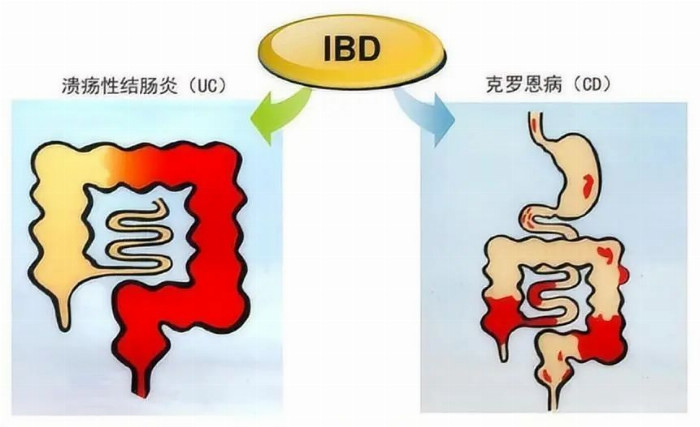 炎症性肠病：揭秘肠道健康与炎症的微妙平衡