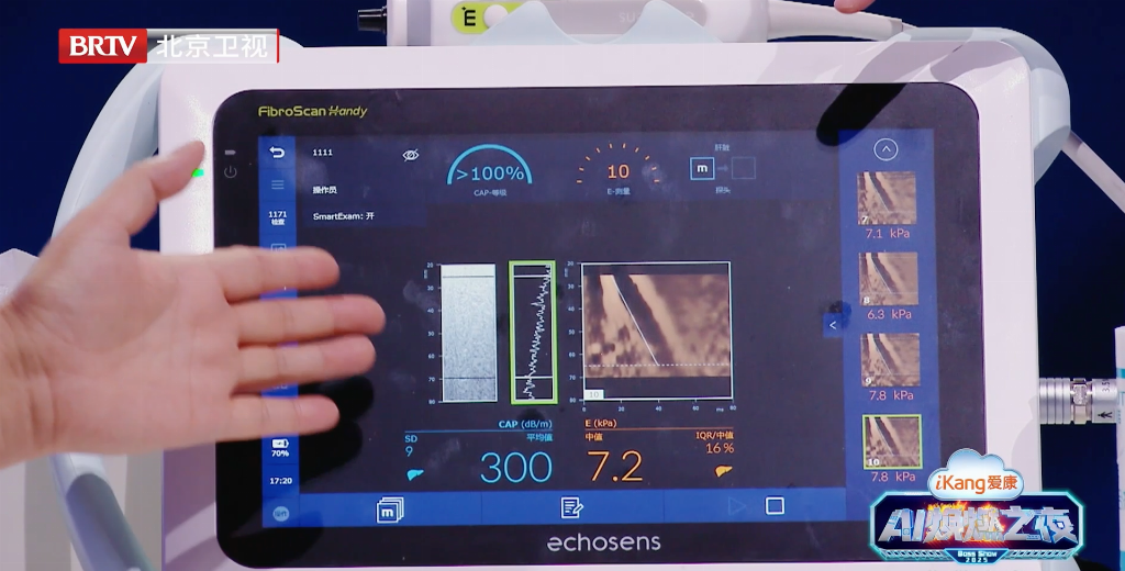 0后演员竟也重度脂肪肝？福瑞股份FibroScan®的独家早筛技术让肝脏不再沉默"