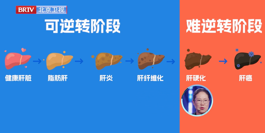 0后演员竟也重度脂肪肝？福瑞股份FibroScan®的独家早筛技术让肝脏不再沉默"